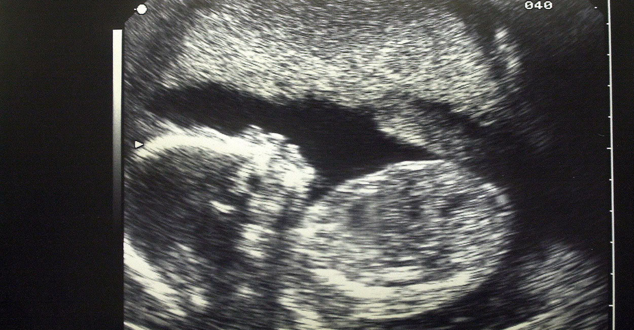 Ultrasound of baby in black and white.